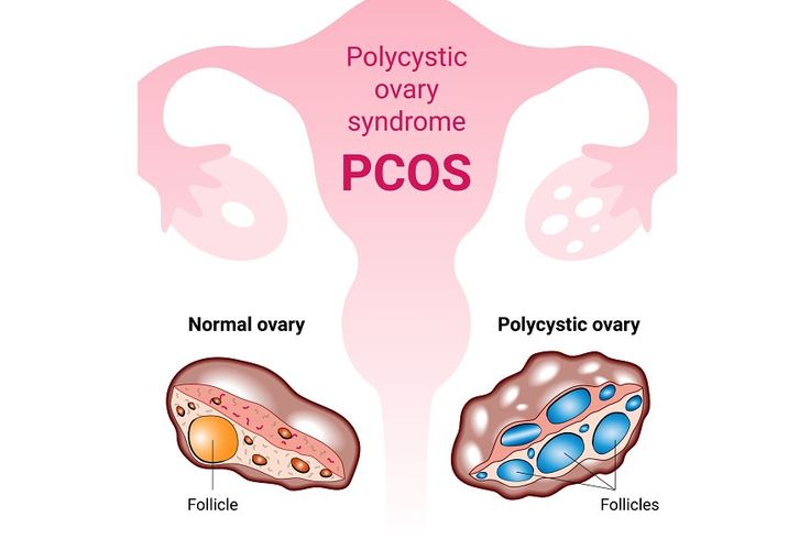 How to Manage PCOS Through Diet and Lifestyle