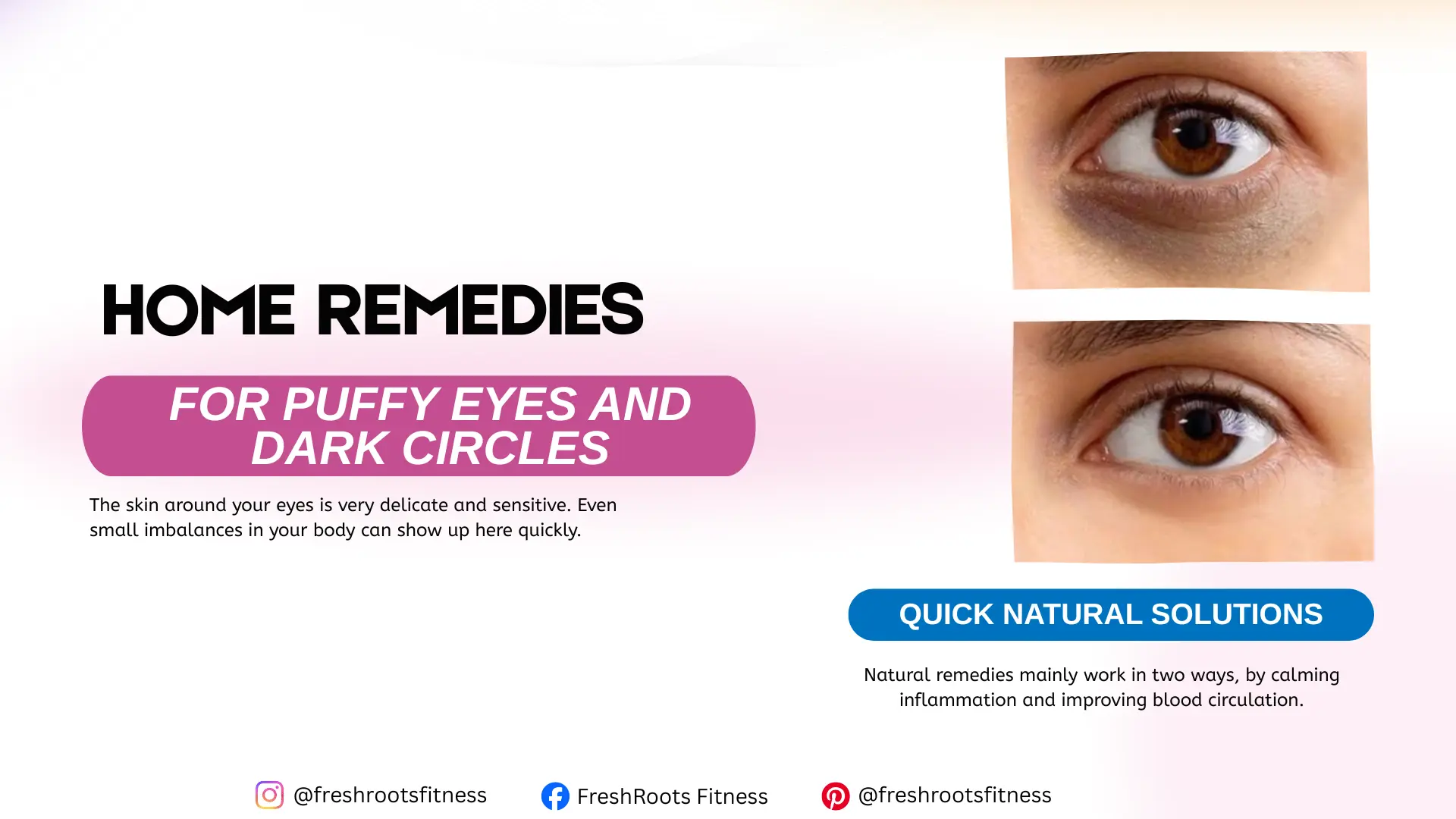 Home Remedies for Puffy Eyes